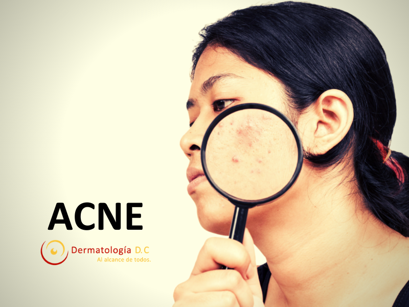 ACNE: ANTIBIOTICOS ORALES POR CUANTO TIEMPO?